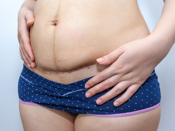 Verheilte Kaiserschnittnarbe nach Kaiserschnitt