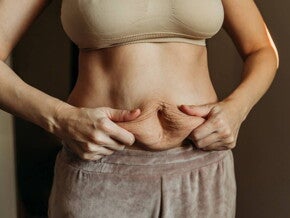 Frau berührt ihren Bauch mit Fettschürze nach einem Kaiserschnitt