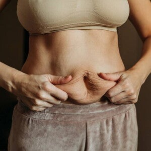 Frau berührt ihren Bauch mit Fettschürze nach einem Kaiserschnitt