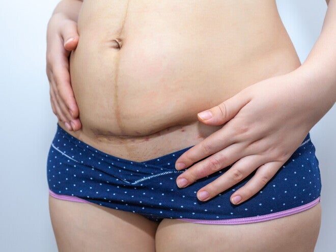 Verheilte Kaiserschnittnarbe nach Kaiserschnitt