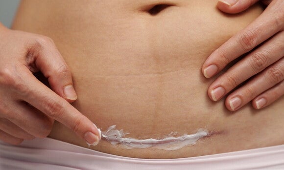 Frau trägt Creme auf ihre Kaiserschnittnarbe auf