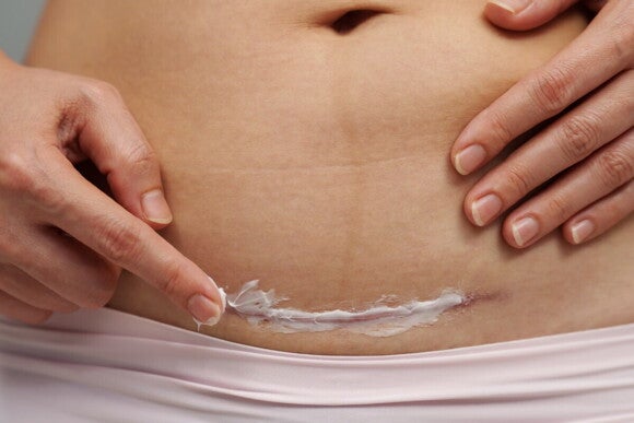 Frau trägt Creme auf ihre Kaiserschnittnarbe auf
