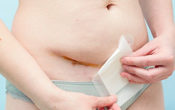 Frische Kaiserschnittnarbe unter Pflaster