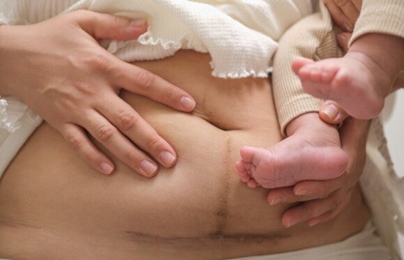 Mutter mit Kaiserschnittnarbe hält ihr neugeborenes Baby