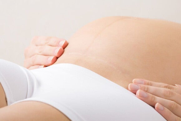 Schwangere Frau mit sichtbarer Kaiserschnittnarbe berührt ihren Bauch mit beiden Händen