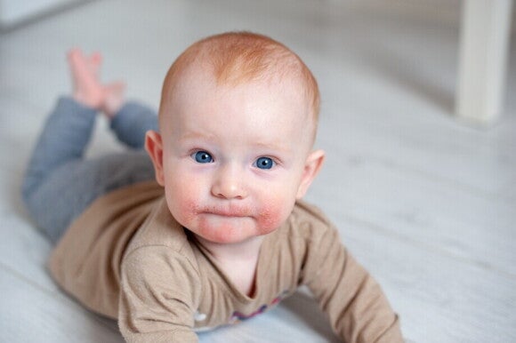 Baby mit allergischem Ausschlag um dein Mund herum Baby mit allergischem Ausschlag um dein Mund herum